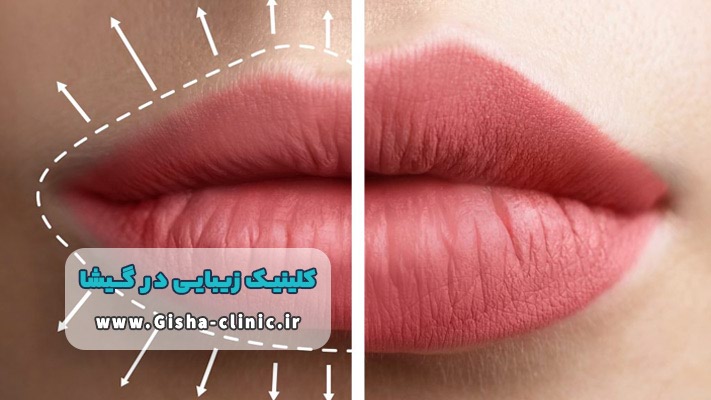 تزریق‌های زیبایی در گیشا: راز فرم‌دهی طبیعی با پُرکننده‌ها و بوتاکس